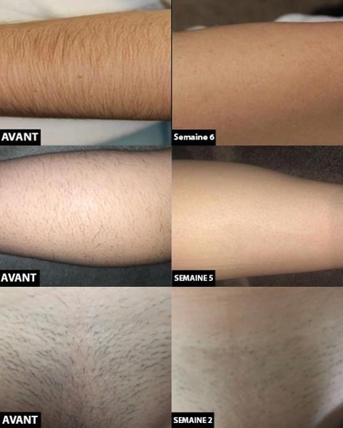IPL Laser Hair Removal Device – Permanent Painless Hair Reduction