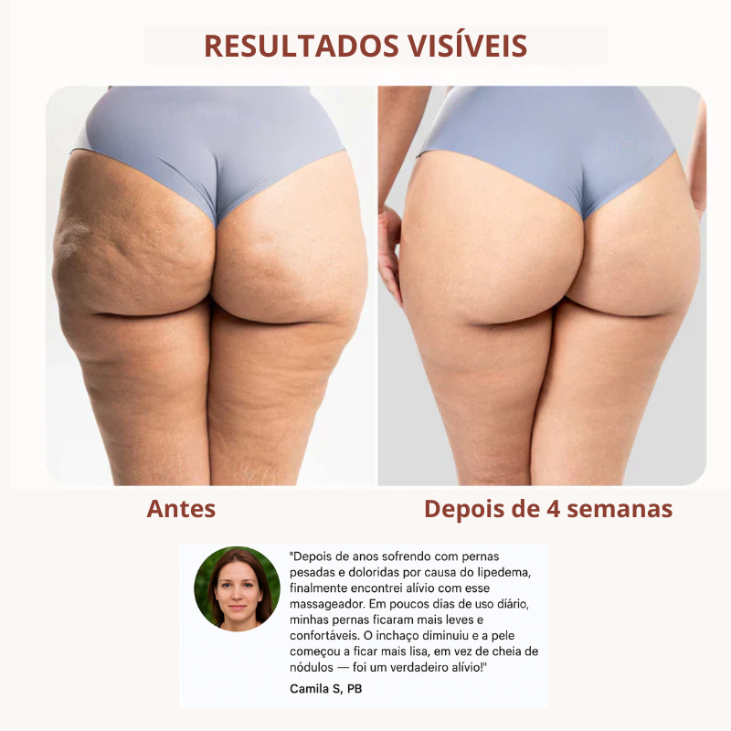 Lymphatic Drainage Roller Massager for Lipedema and Cellulite