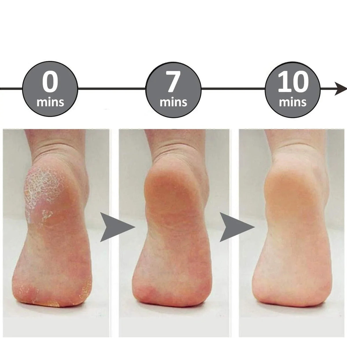 Professional Foot File Callus Remover